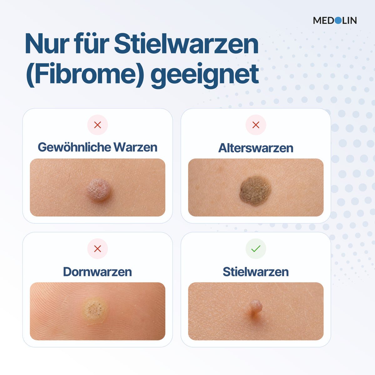 Medolin Stielwarzen Weg