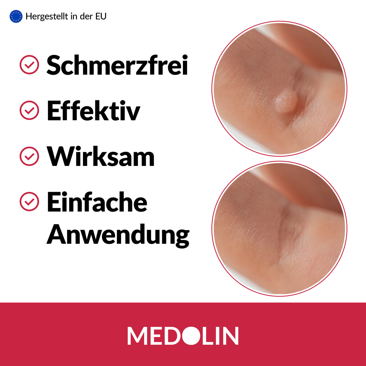 2x Medolin Warzenpflaster