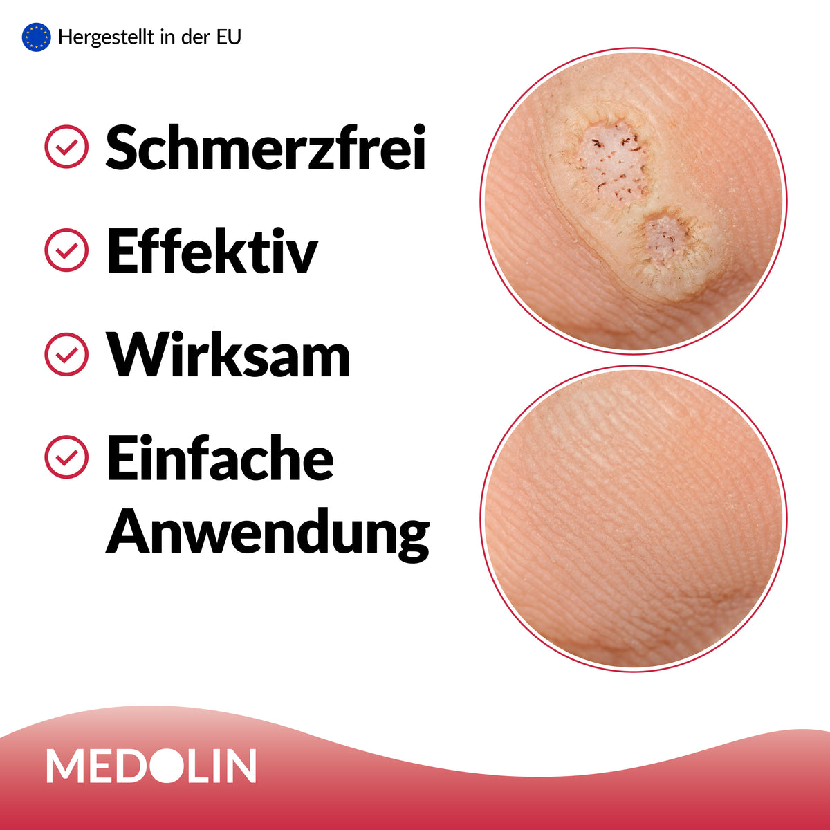 Medolin Dornwarzenpflaster