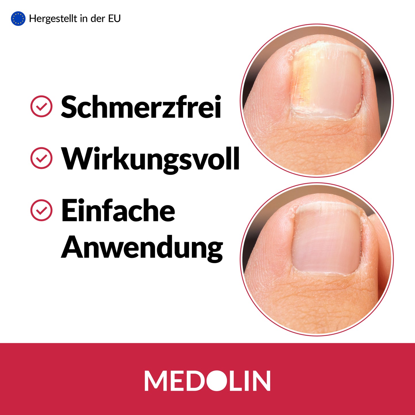 Medolin Nagelpilz Lösung