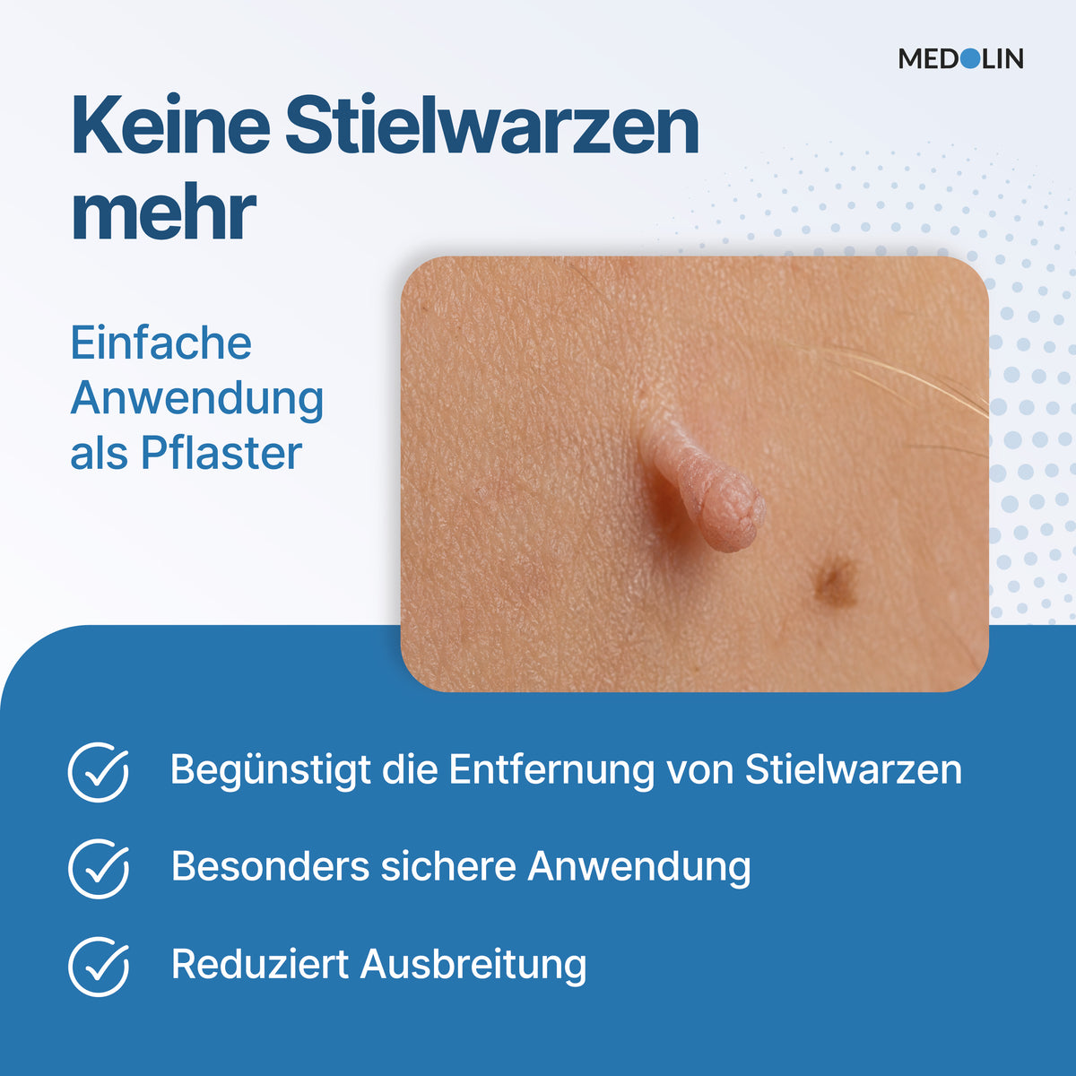 Medolin Stielwarzen Weg